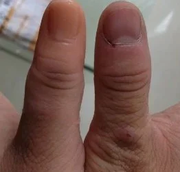 The Disabled Finger Fake Finger Glove The Disabled Finger Custom-made Fake Palm Simulation