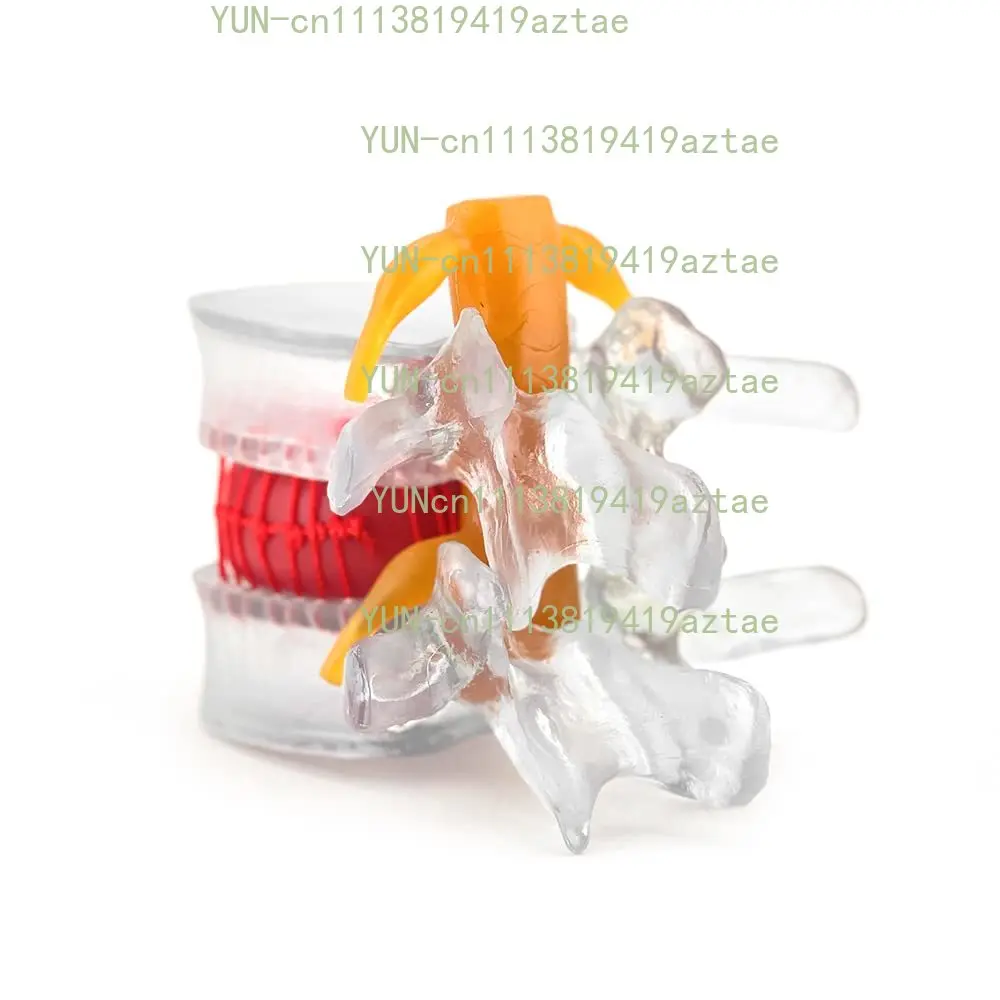 Transparent Intervertebral Disc Protrusion Model -1.5 Times Human Size Lumbar Disc Protrusion Model Learning and Teaching Tool