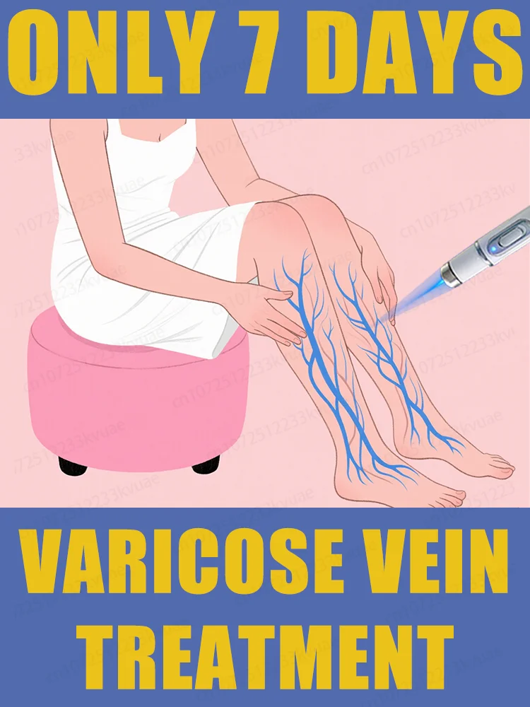 

Generation-2 Laser Says Goodbye To Spider Legs Varicose In 7 Days