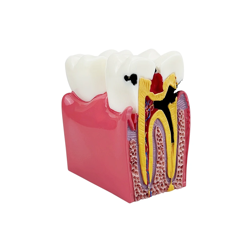 Dental 6 Times Teeth Model Caries Comparsion Models Study Denture Teaching Anatomy Education Teeth Model For Dental Study