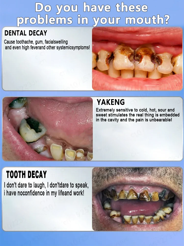 Use natural plant extracts to repair tooth decay, whiten teeth, and remove tooth decay