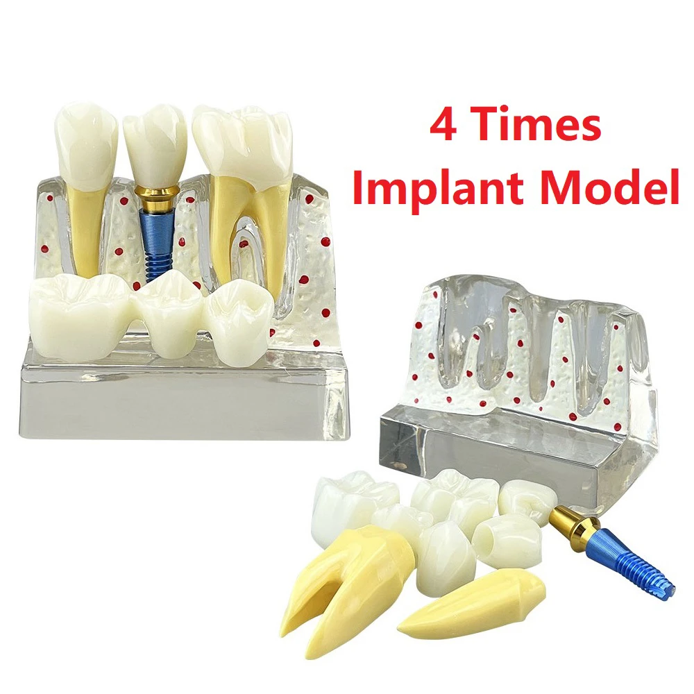 Dental Implant Training Model 4 Times Implant Analysis Crown Bridge Teeth Model Dentist Demonstration Model For Teaching Study