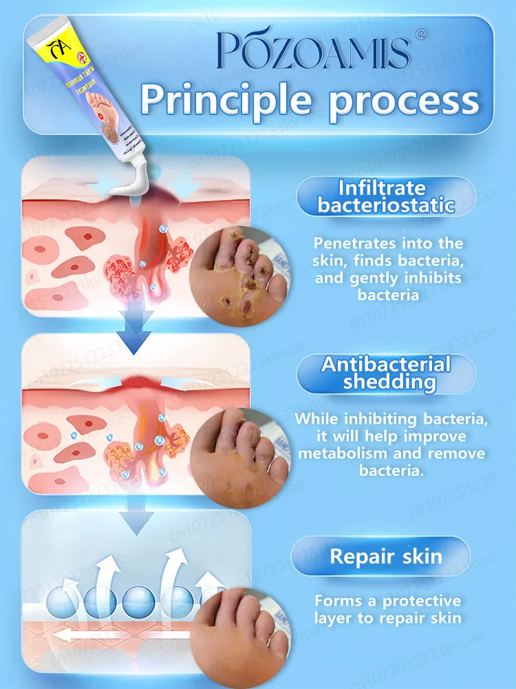 Crema para eliminar verrugas VPH Verrugas genitales Verrugas plantares