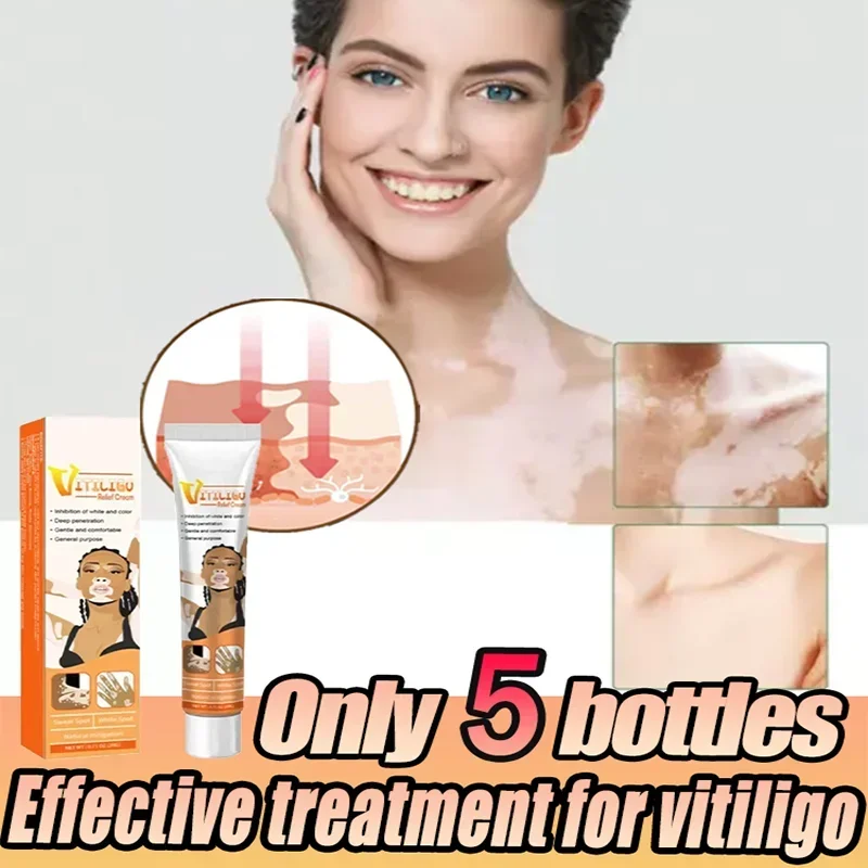 schöne Vitiligo-Creme, entfernt Ringelflechte, entfernt weiße Flecken, Hautvitiligo, beseitigt Vitiligo-Creme