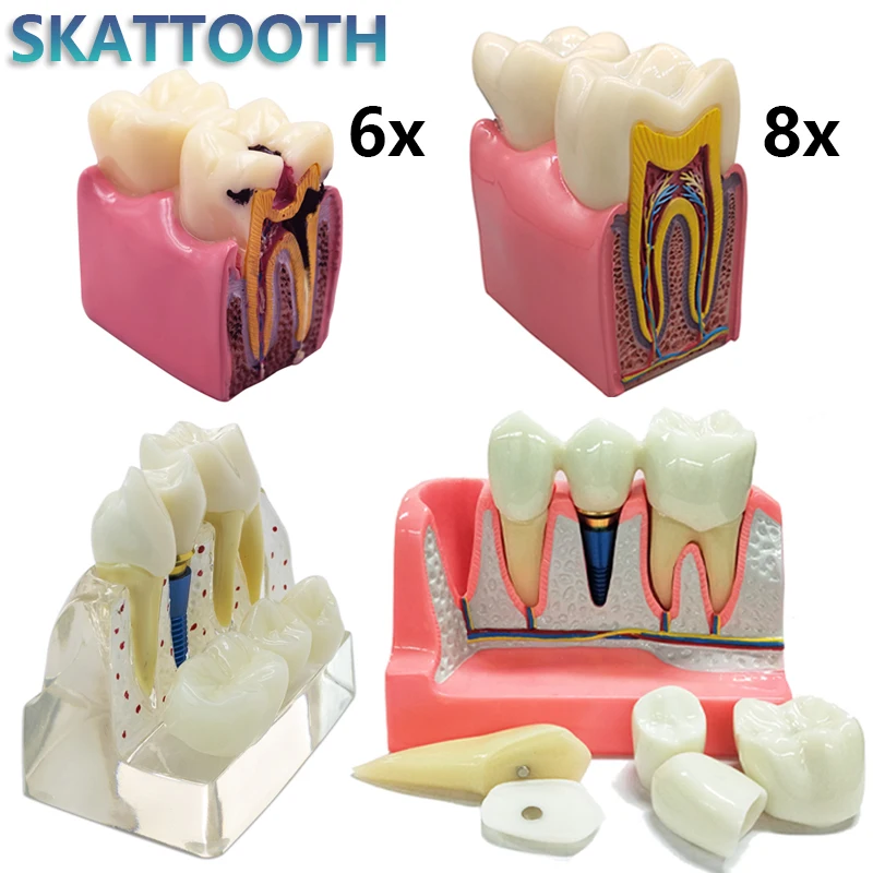 Dental Implant Model 6/8x Magnified Caries Contrast Tooth Model Crown Dental Implant Models for Doctor-patient Communication