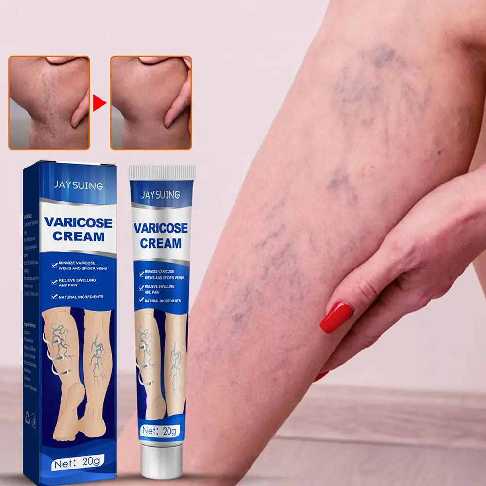 ointment for varicose veins Effective varicose vein relief cream to relieve Leg vasculitis phlebitis spider pain treatment L8P1