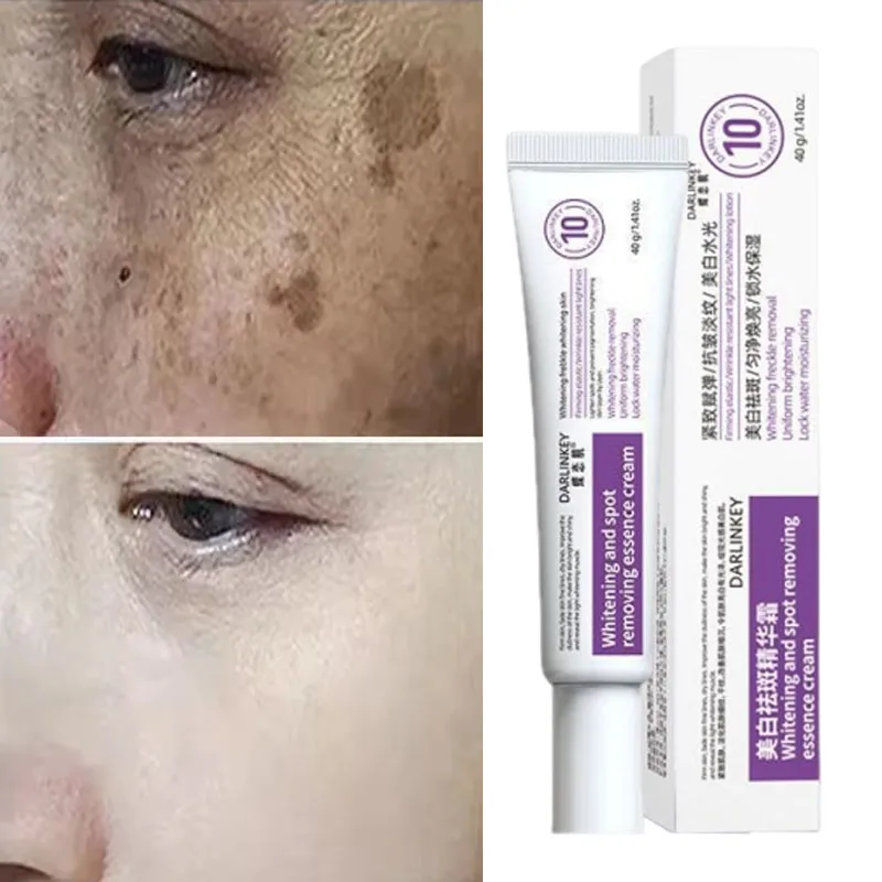 Potente crema blanqueadora eliminadora de manchas, ilumina la piel, elimina la pigmentación de melanina, Melasma, manchas oscuras, Gel de belleza hidratante