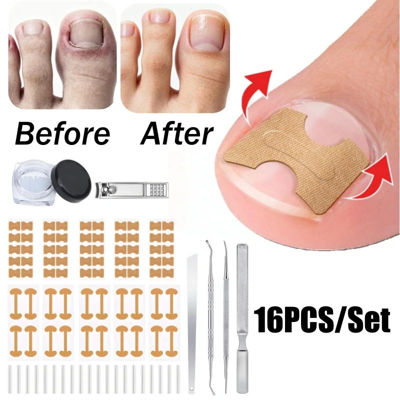 Kit zur Korrektur eingewachsener Zehennägel, Zehennagel-Korrekturstreifen, Patches, Pads mit Nagelknipser, Feile, Lücke, Zehennagelfüller, Entfernung
