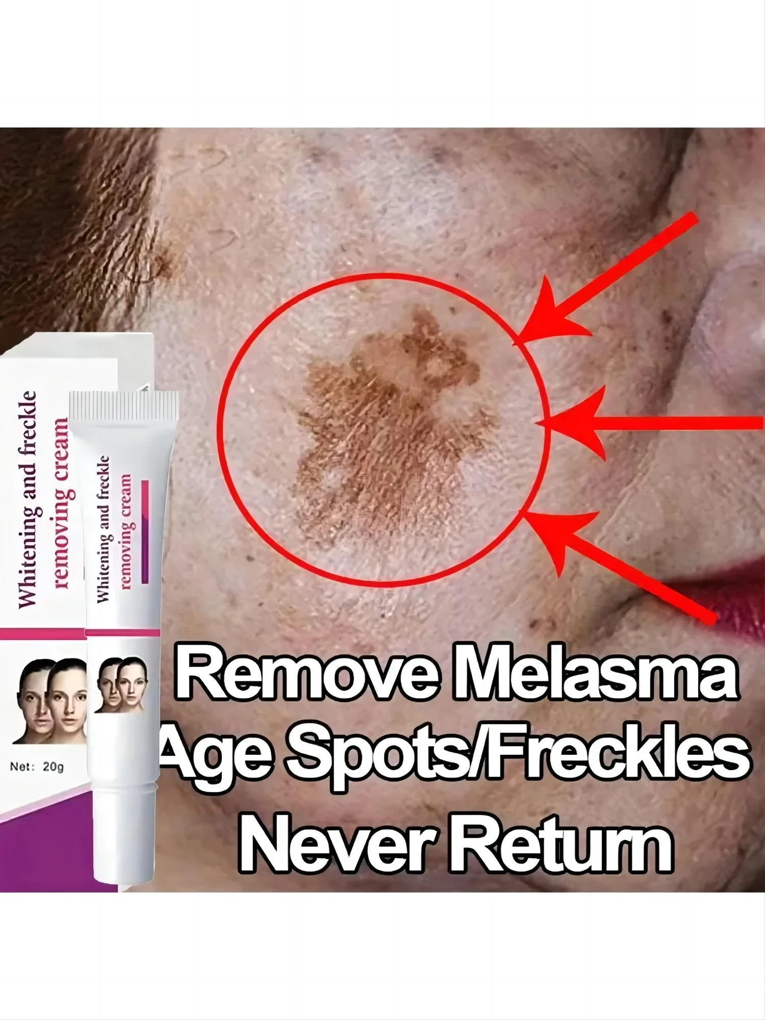 Freckles Removal Cream Remove Facial Spots Skin Dark Spot Remove Melasma Age Spots Sunspots Whitening And Freckle Removing Cream