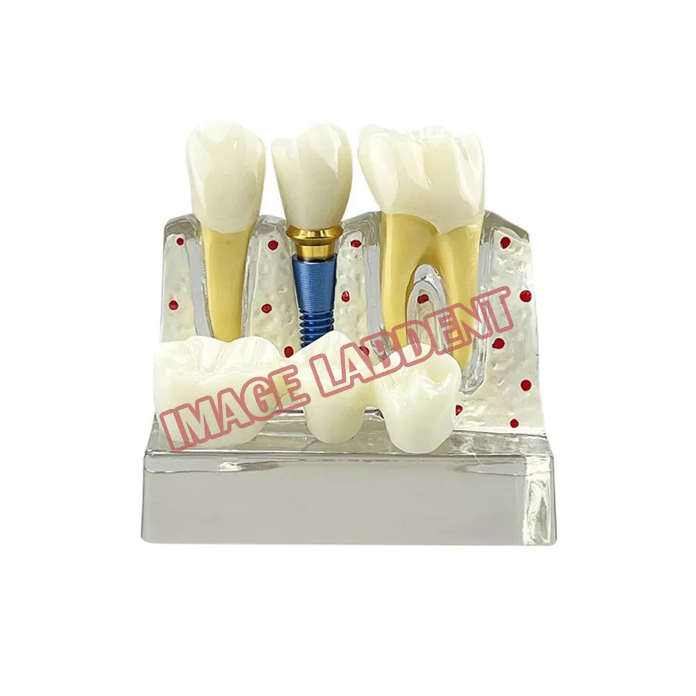 4 Times Dental Implant Demonstration Model Teeth Implant Analysis Crown Bridge Removable Model For Dentist Student Teach Study