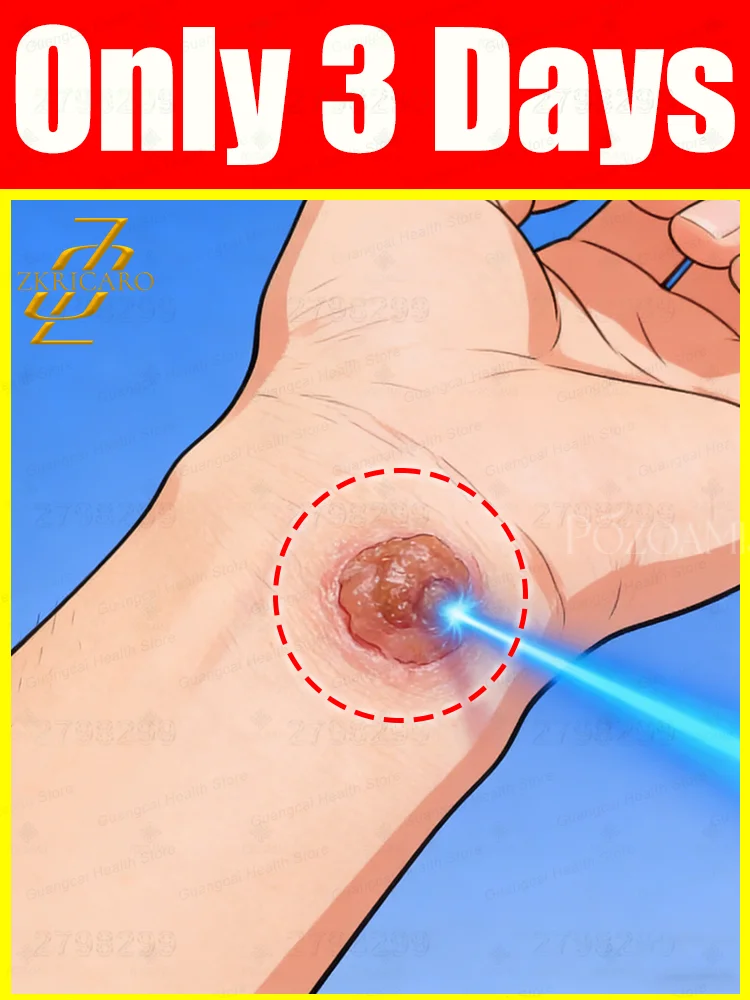 جذر إصلاح الثآليل الجيل السادس عشر المحسن بسرعة واحدة #1