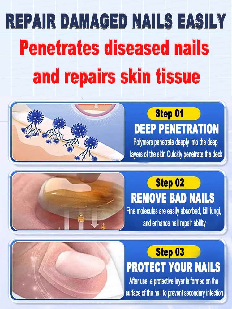 Schnelle Sterilisation, Reparatur von Onychomykose
