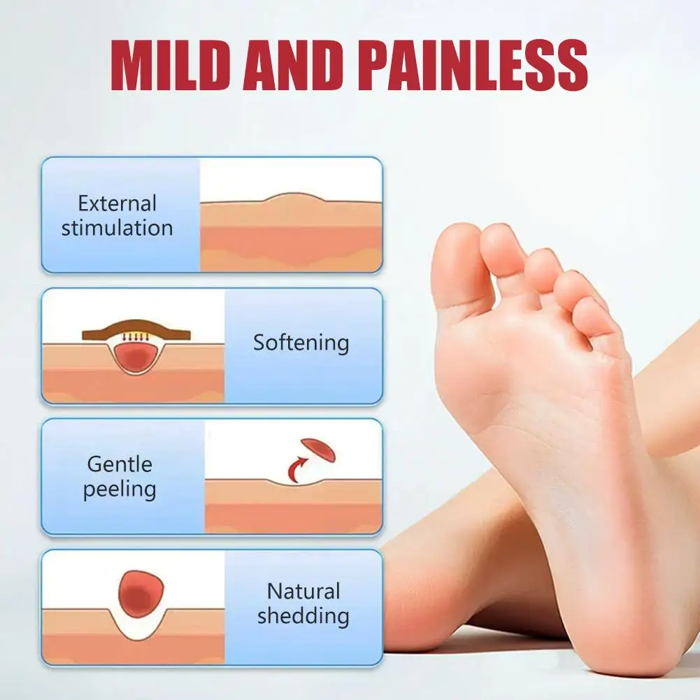 1/5pcs Corns Removal Patch Foot Corn Plaster Killer Calluses Plantar Warts Thorn Plaster Breathable Remove Corns Calluses Corn P - view 5