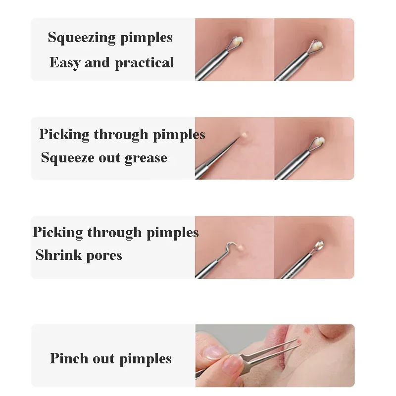 Hoge Kwaliteit Acne Mee-eter Verwijdering Kit Neus Gezicht Porie Reiniging Acne Naald voor Ingegroeid Haar Comedonen Extractor Huidverzorging Tool