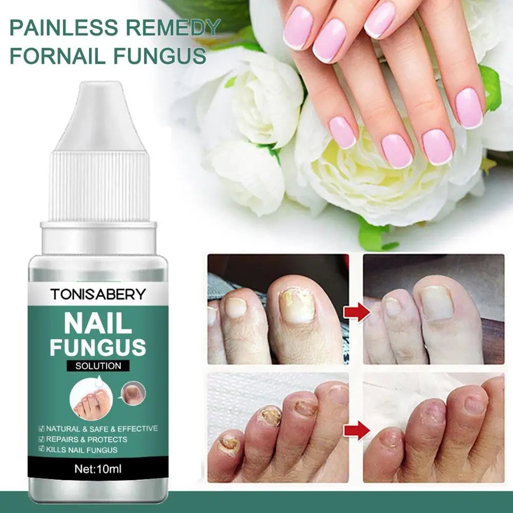 

Nail Fungal Treatment Feet Care Essence Anti Infection Body Fungus Onychomycosis Nail Paronychia Removal Care Nail Foot Toe L9M8