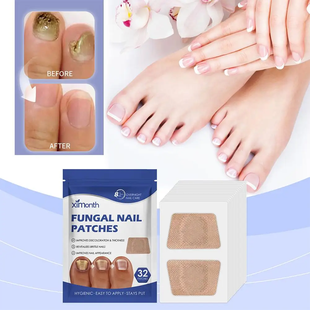 32 Teile/schachtel Universal Nagel Graben Reparatur Patch Kompakte Nagel Reparatur Aufkleber Eingewachsene Zehennagel Korrektur Aufkleber Fuß Pflege