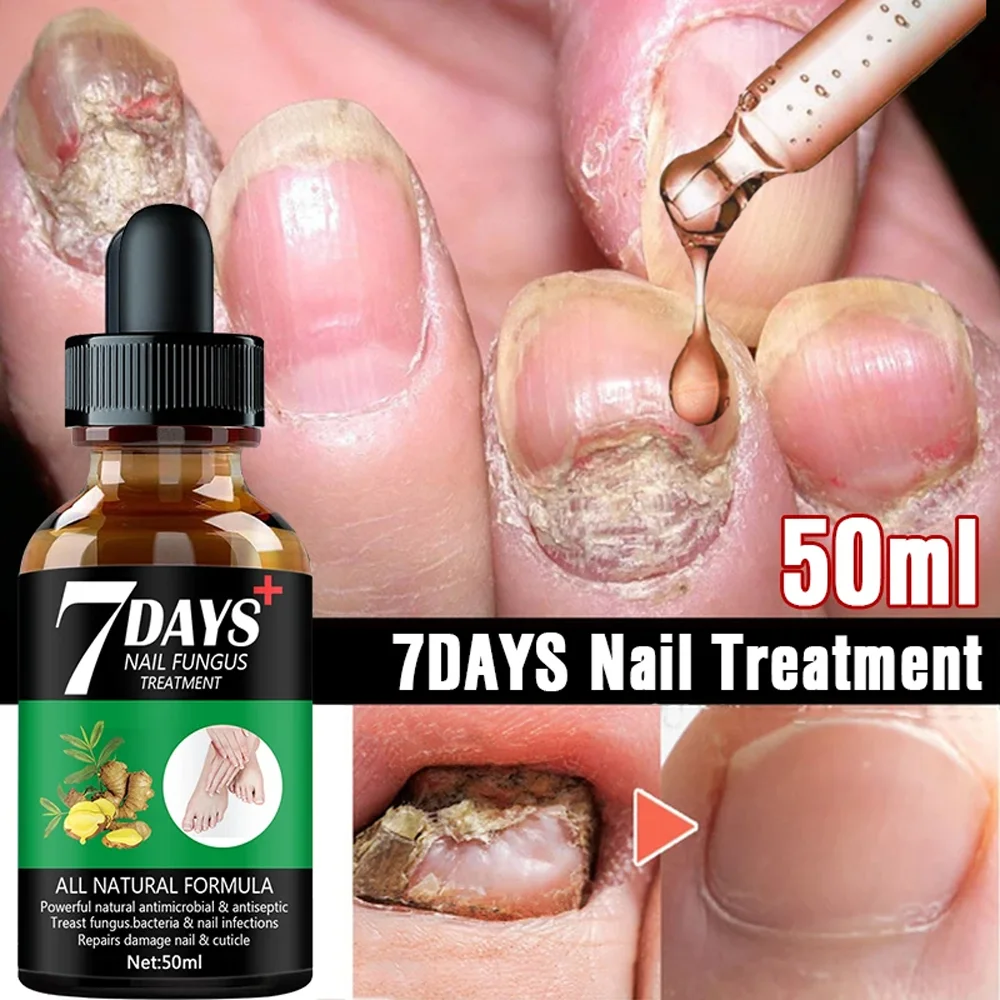 Essence de traitement fongique des ongles, réparation rapide des champignons, appareil laser, champignon, onychomycose, élimine les champignons des ongles, outil de soin des pieds, N64