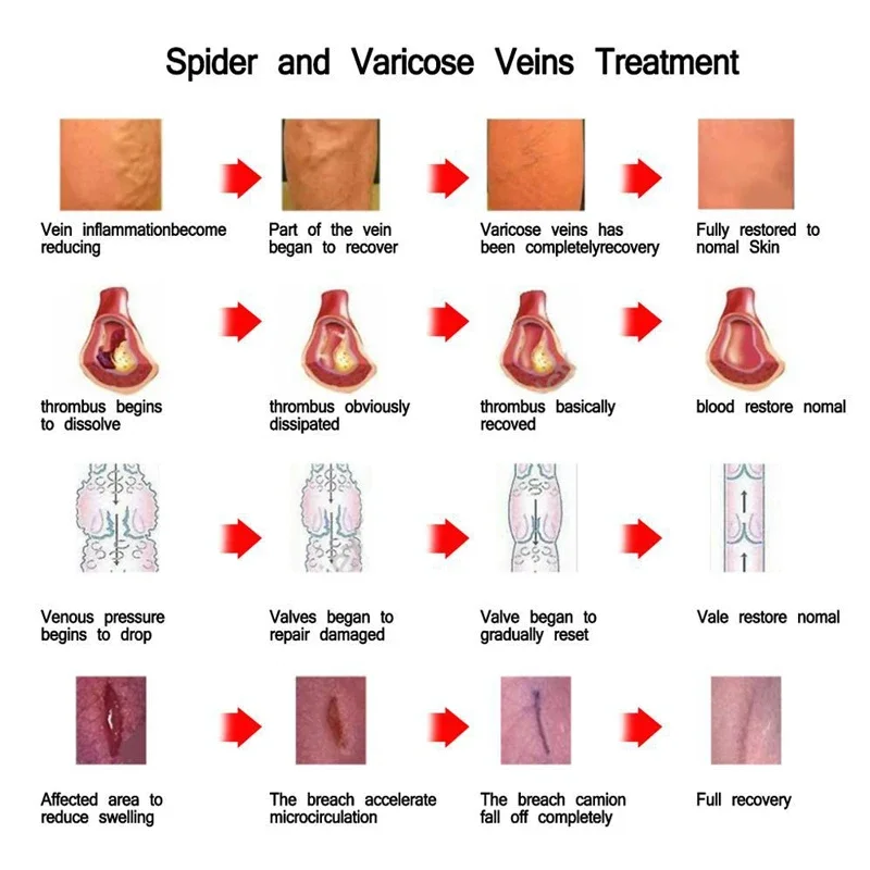 얼굴 정맥류 방지 크림, 홍조 방지 거미 정맥 제거제, 고급 치료, 피부 정맥 클리어