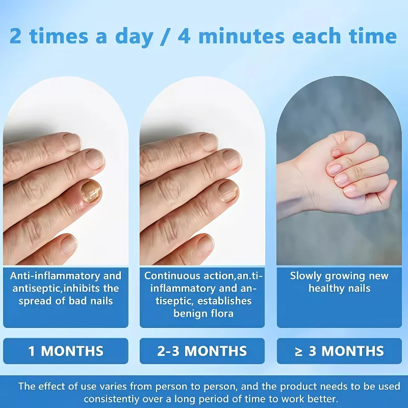 

Лазерное устройство для лечения онихомикоза, терапия грибка ногтей 905 нм 470 нм для лечения грибковых ногтей на ногах и ногах