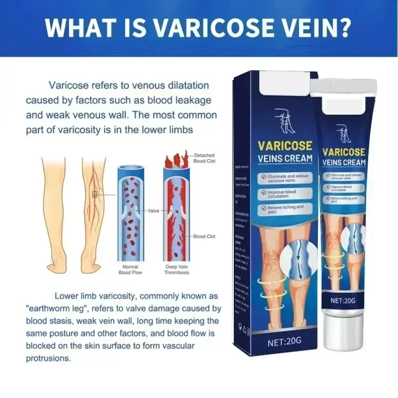 Varicose Veins Vasculitis Phlebitis Spider Cream Varicosity Angiitis Removal Herbal Medical Plaster A081