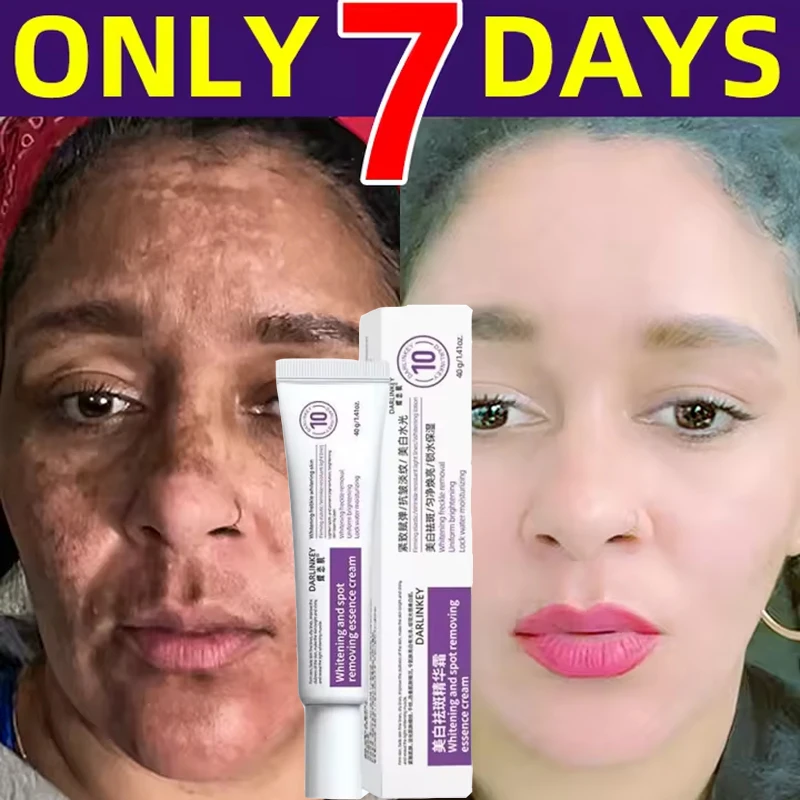 

Powerful Spot-removing Whiten Cream Brighten Skin Fast Eliminates Melanin Pigmentation Melasma Dark Spots Moisturize Beauty Gel