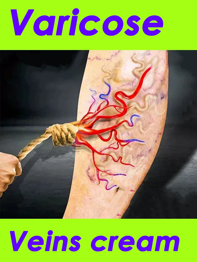 

Herbal Varicose Spider Veins Cream Leg Cream
