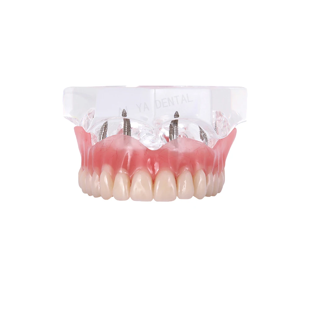 Dental Teeth Model Dental Implant Overdenture Model Upper Lower Mndibular Model For Dentist Patient Communication Demo