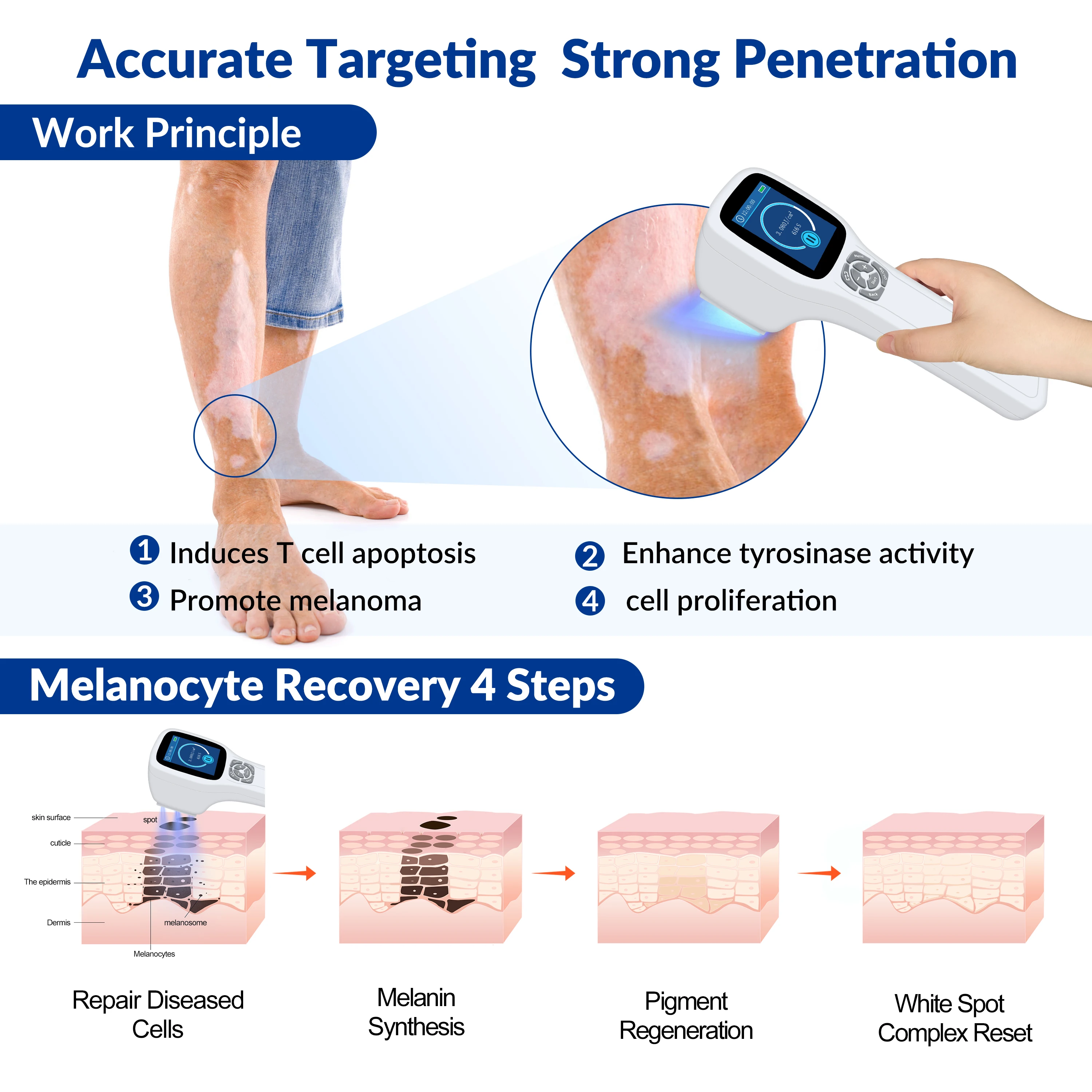 ZJZK Psoriasis Light Therapy Device Photo RejUVenation 308nmx49diodes Handheld UV Light For Psoriasis Sores Lichen Planus