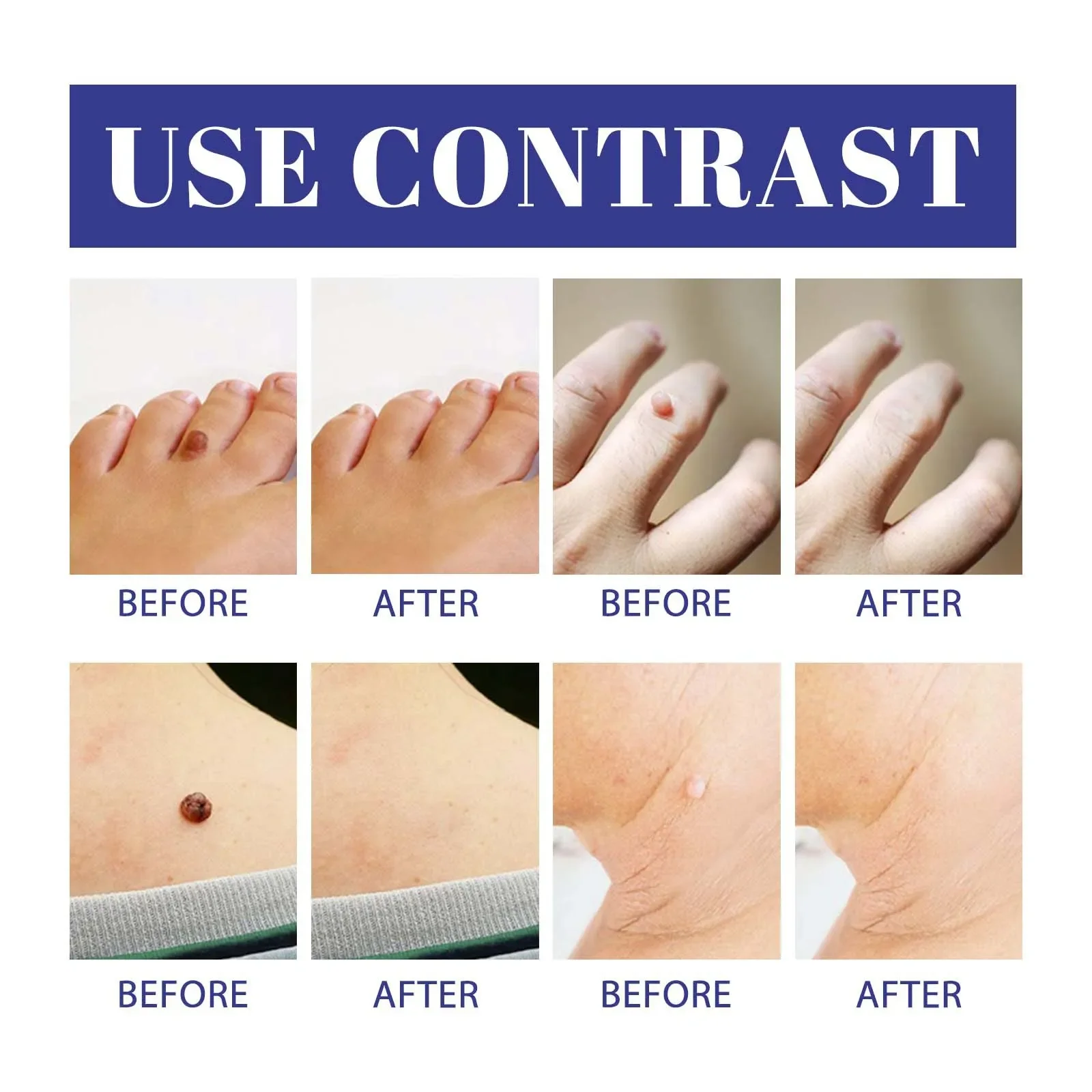 2 in1 무통증 피부 태그 점 제거 키트 클리닝 도구 얼굴 피부 관리 바디 점 치료 제거기 뷰티 헬스