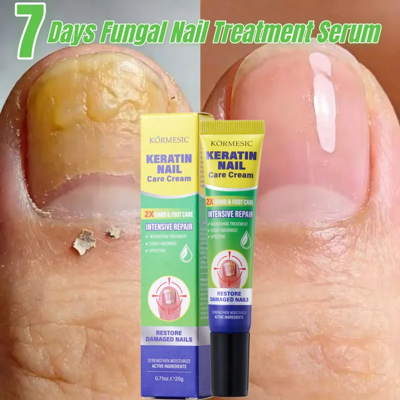 

Nail Fungus Care Cream Anti-Infection Onychomycosis Damaged Cracked Hand Foot Nail Repair Gel Manicureed Health Care Essence