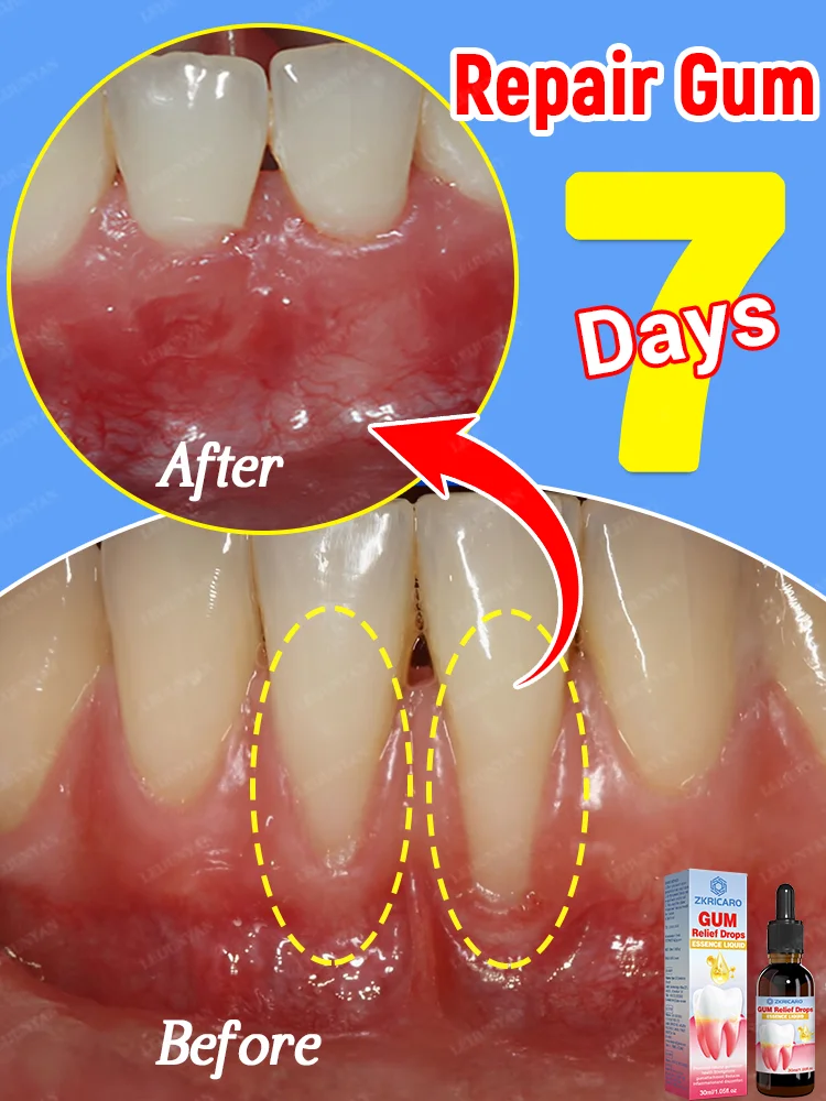 The world's best-selling gum drops,Get rid of Gum recession, bleeding teeth, sensitive teeth, inability to eat, strong teeth