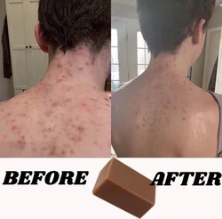 100g Body Acne Soap Back Acne Treatment Clear Spots Blemish Blackheads Refreshing and Moisturizing Cleansing Mites