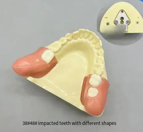 Dental Impaired Tooth Extraction Practice Model Dental Replaceable Impaired Tooth Wisdom Teeth Practice Model