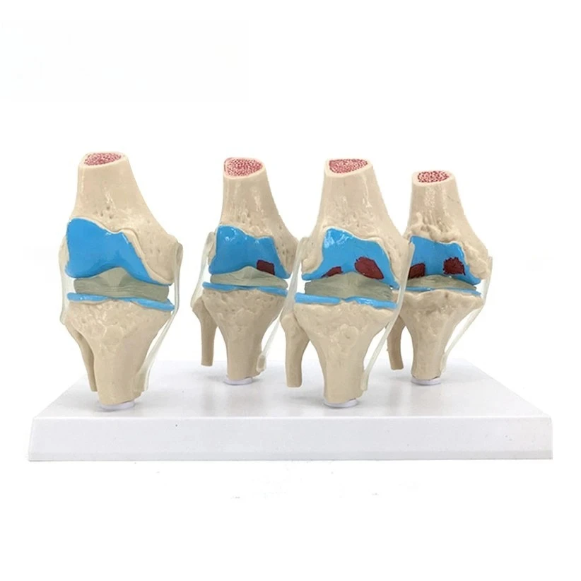 Human Knee Joint Pathological Model 4‑Stage Osteoarthritis Anatomical Demonstration Specimen for Medical Teaching Clinical