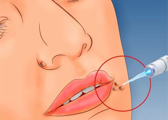 

Ручка с синим светом решает бородавки, горячие инструменты для ухода за бородавками