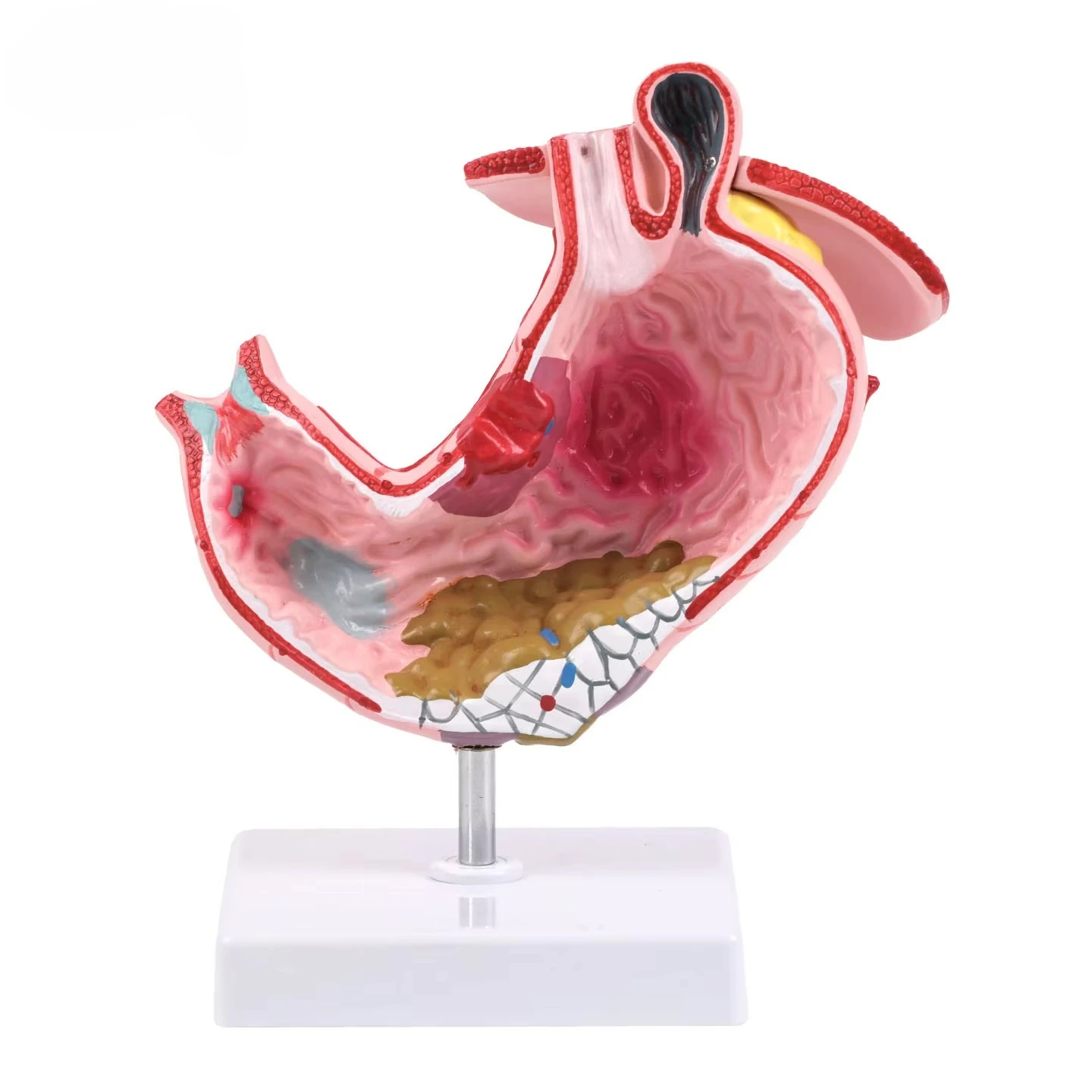 

Pathological Stomach Model Human Digestive System Anatomy Coronal Section Anatomy Pathological Stomach Model