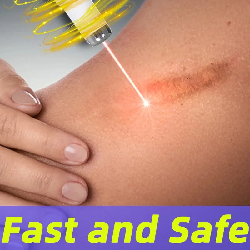 Laser Therapy Keloid Scar Skin Care