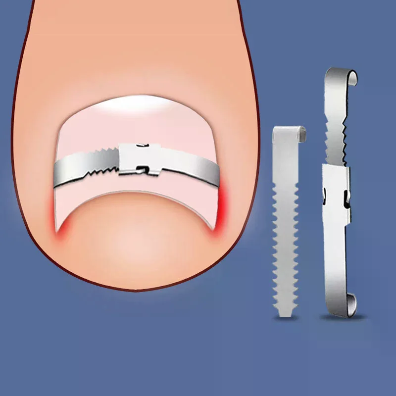 

Инструменты для коррекции вросших ногтей на ногах для педикюра - профессиональное средство для ухода за ногами при вросших ногтях