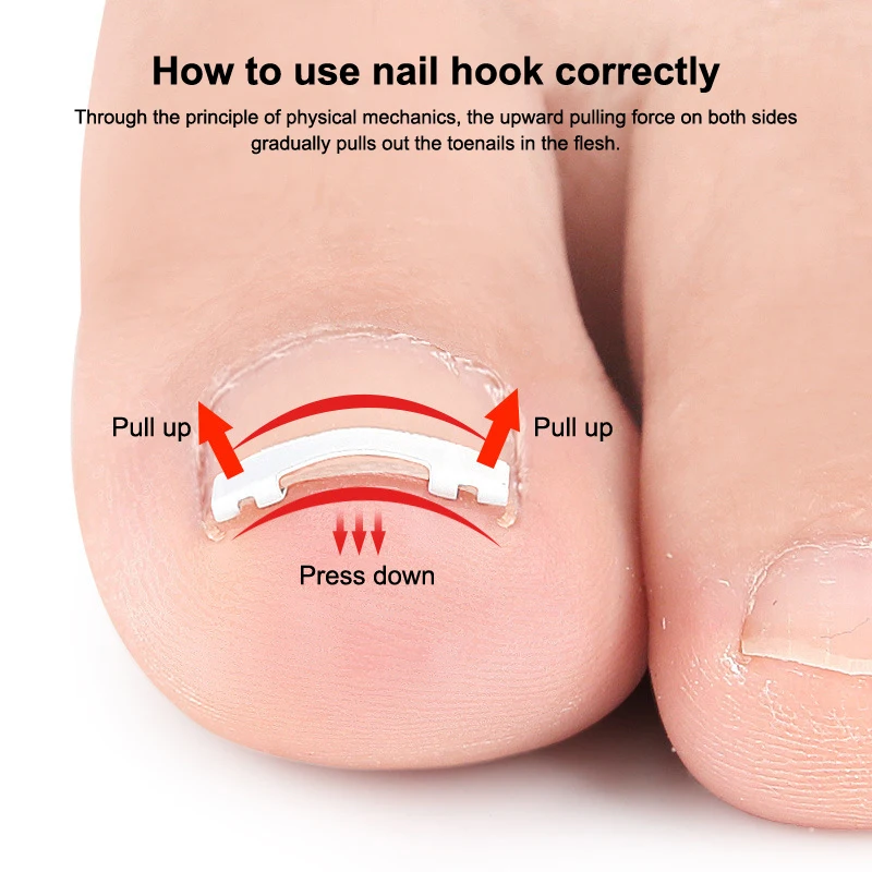 내성발톱 교정기 도구 1개, 페디큐어, 내성발톱 치료, 전문가용 내성발톱 교정, 발 관리