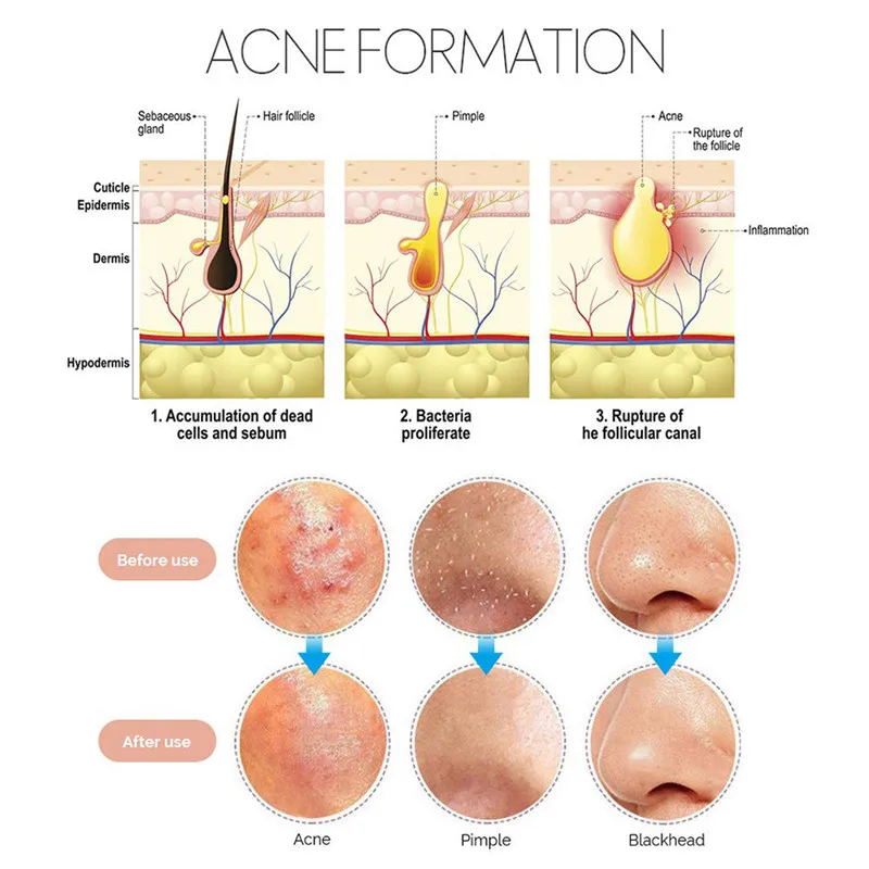 Stainless Steel Acne Removal Blackhead Comedone Acne Blemish Extractor Remover Face Skin Care Pore Cleaner Needles Remove Tools