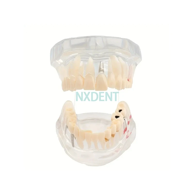 Modèle dentaire Transparent, réparation du nerf dentaire, pathologie, pont dentaire, outil de démonstration dentaire amovible, enseignement pratique pour dentiste