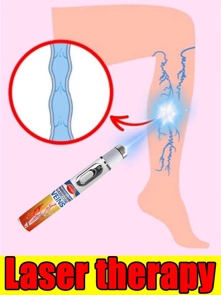 Removal of varicose veins