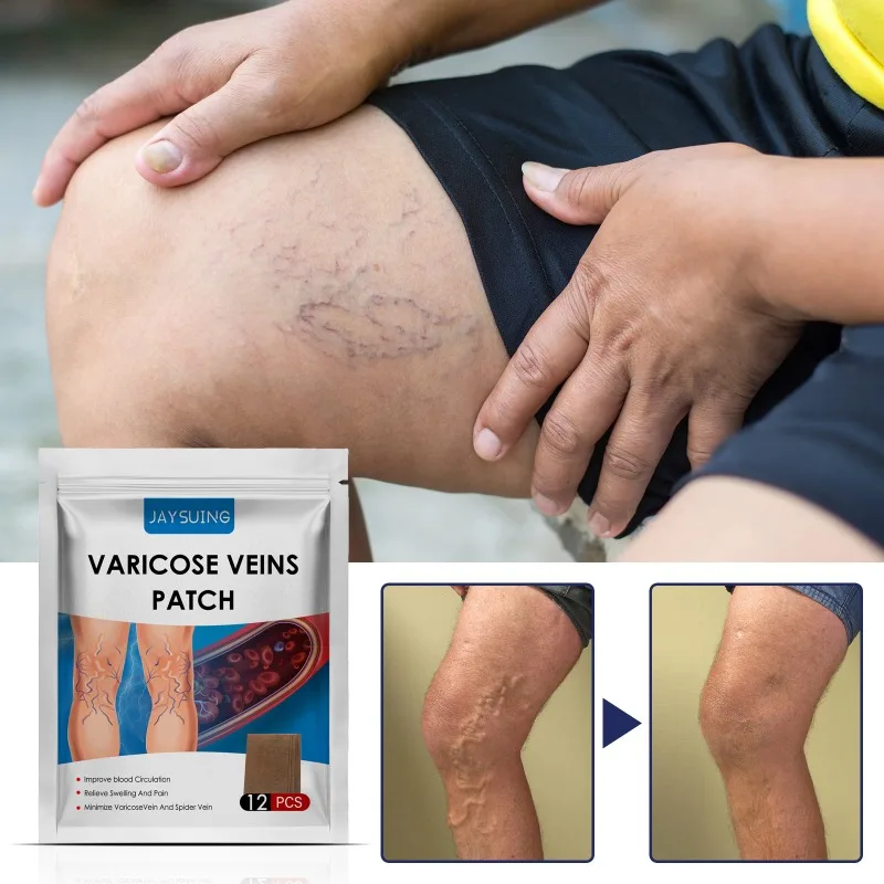 Varicose Veins Patch Thigh Leg Pain Spider Removal Phlebitis Plaster Feet Anti Swelling Promote Smooth Blood Circulation Care