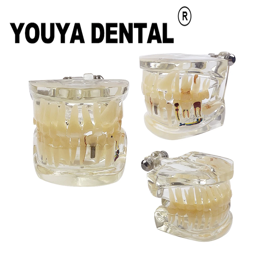 

Dental Left Mandibular Anatomic Pathological Model Disease Teeth Model for Dentist Practice Studying Oral Medical Dentistry Tool