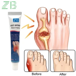 ZB 20g Foot Gout Treatment Cream Thumb Corrector Finger Hallux Ointment Toe Bunion Pain Relieve Medical Plaster Health Care