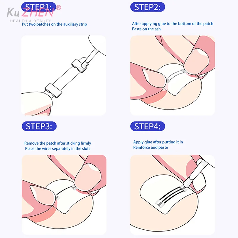 1세트 내향성 발톱 교정 클립 보조 도구 페디큐어 회복 내장형 발톱 치료 전문가용 내향성 발톱 교정기