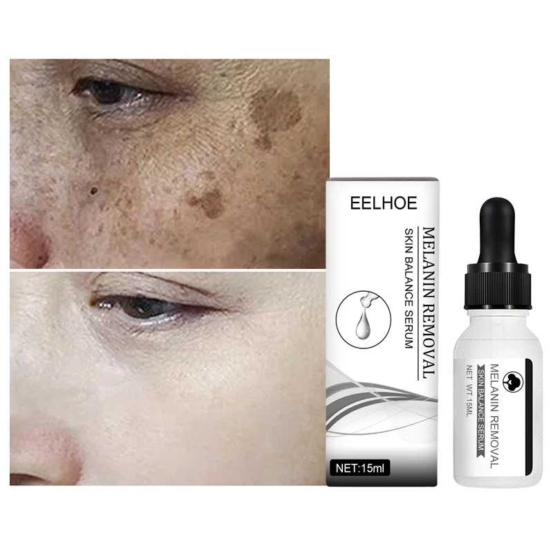 Powerful Removal Dark Spots Black Dot Melasma Chloasma Whitening Face Cream Niacinamide Freckle Removing Moisture Face Skin Care