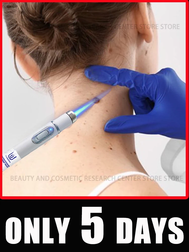 

Лазерная ручка для удаления бородавок