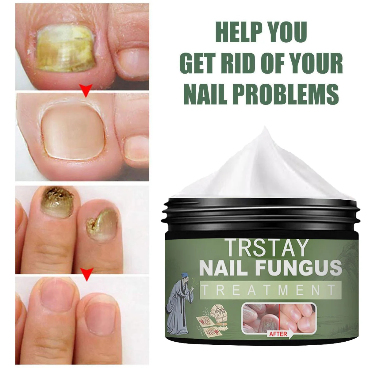 Nail Fungal Treatment Cream