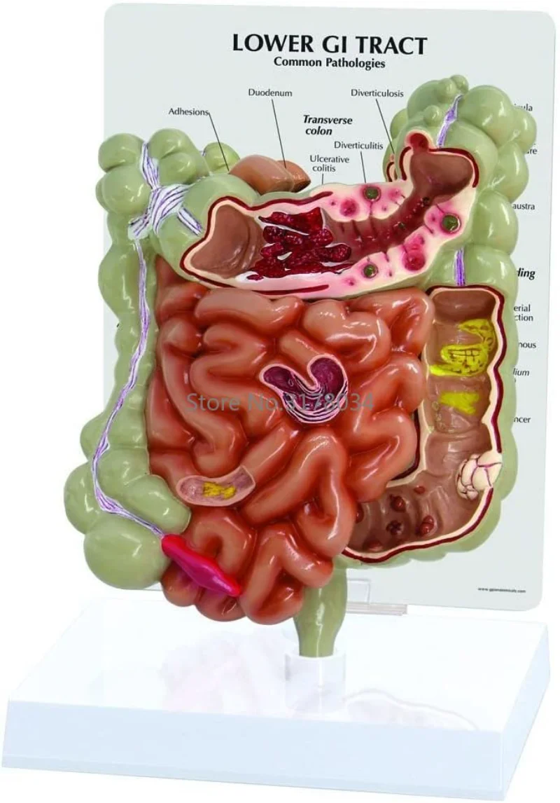 

GI Tract Model Lower GI Model Human Body Anatomy Doctors Office Educational Tool